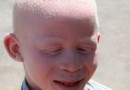 African Albinos are killed for their body Parts…(a tragedy of double discrimination & persecution)